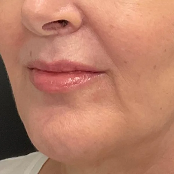 After lip filler