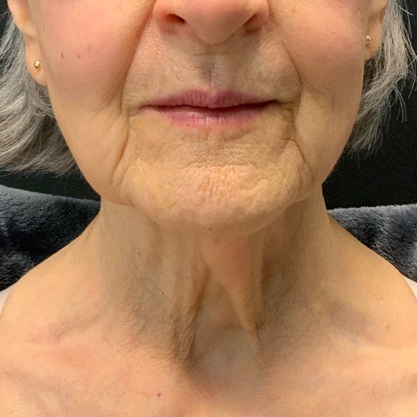 Before Agnes RF + Scarlet SRF Lift