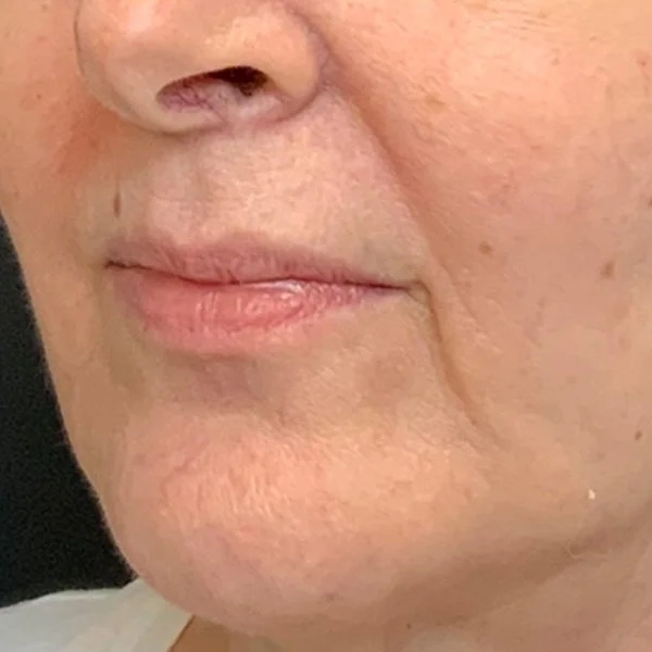 Before Lip Filler