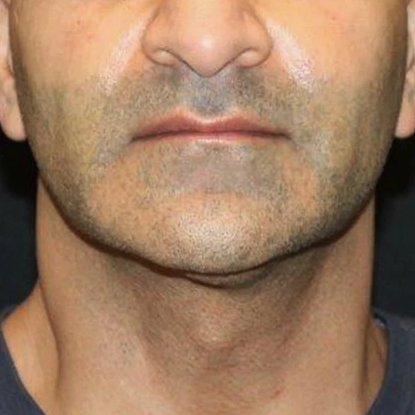 After CoolSculpting Chin