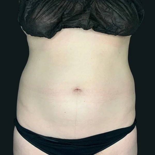 After CoolSculpting