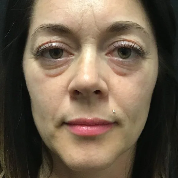 Before anti-aging regimen