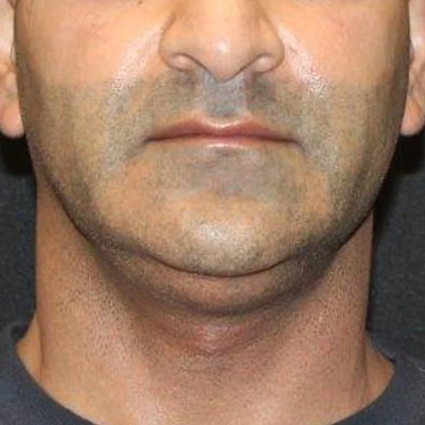 Before CoolSculpting Chin