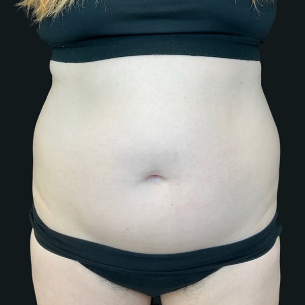 Before CoolSculpting