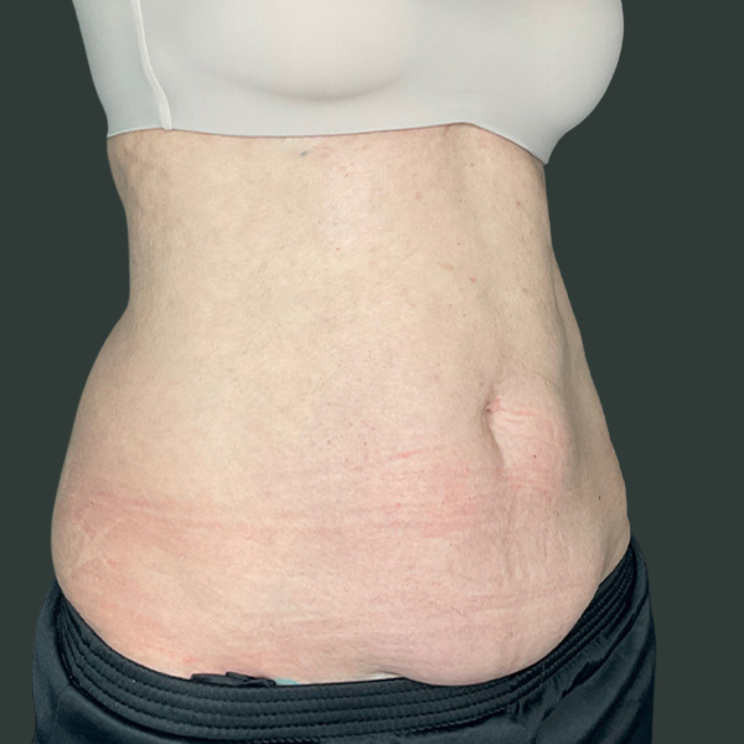 After CoolSculpting