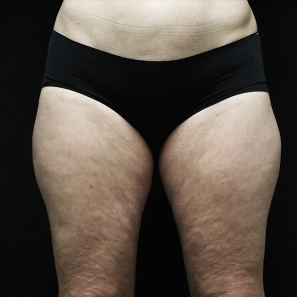 Before CoolSculpting Thighs