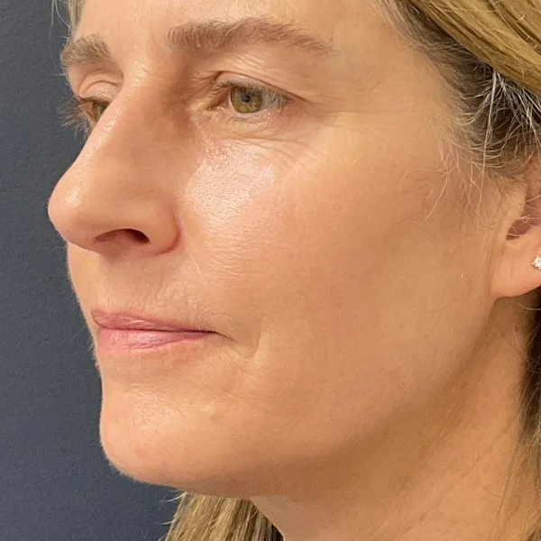 After Sculptra 