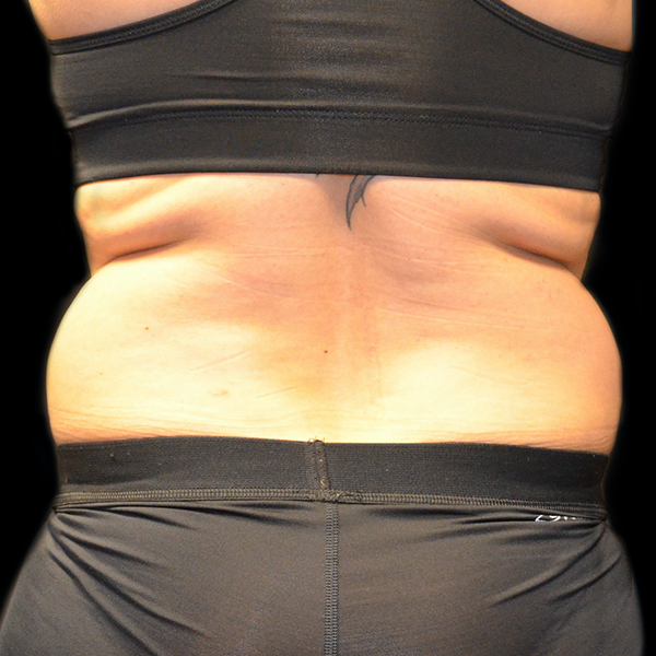 Before CoolSculpting Love Handles