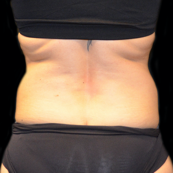 After CoolSculpting Love Handles