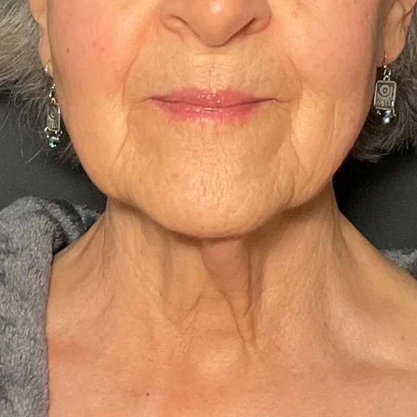 After Agnes RF + Scarlet SRF Lift