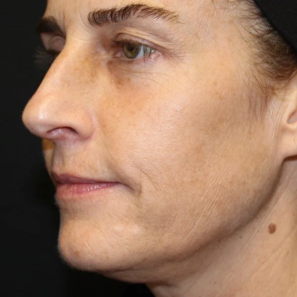 Before Sculptra