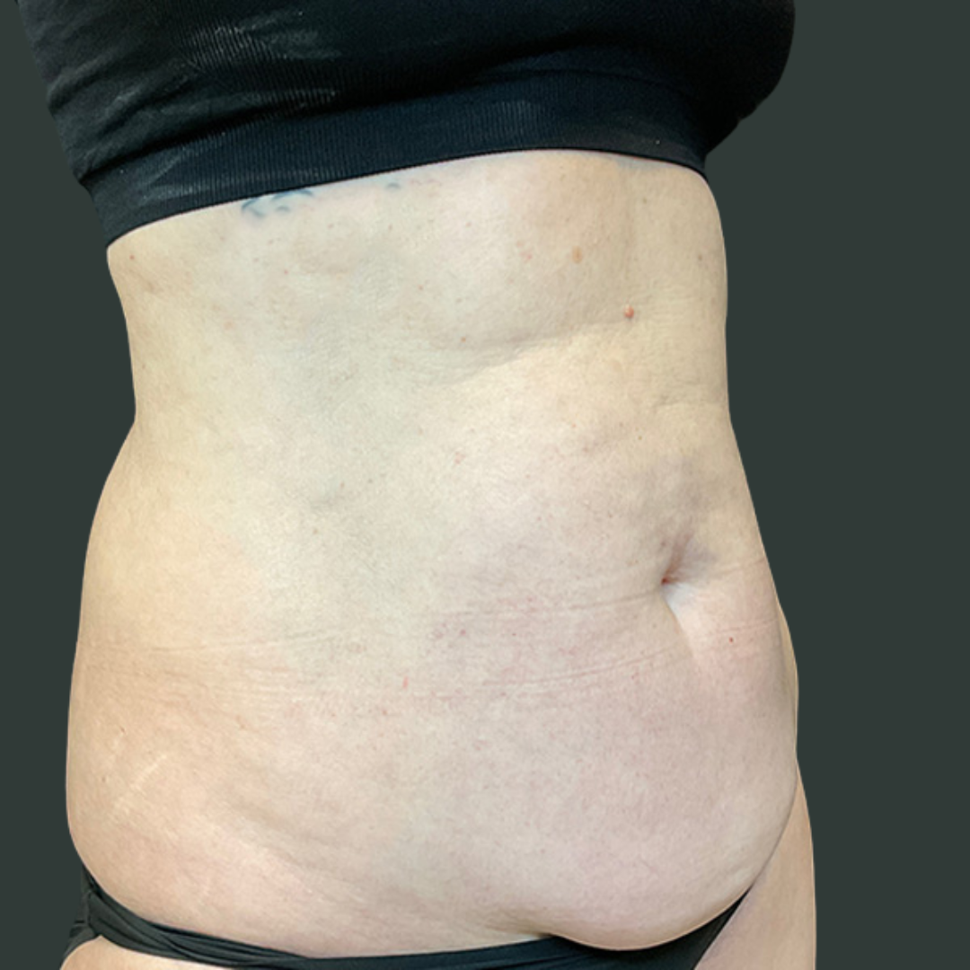 Before CoolSculpting