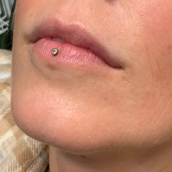 Before Lip Filler