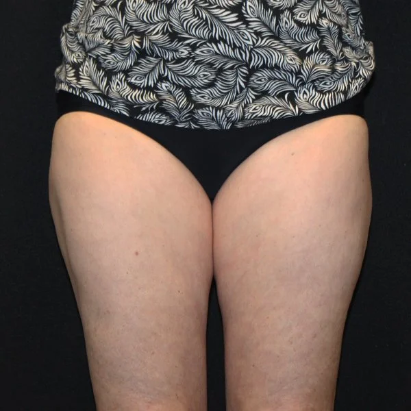 After CoolSculpting Thighs