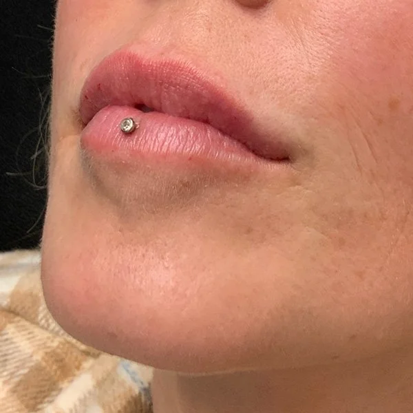 After Lip Filler