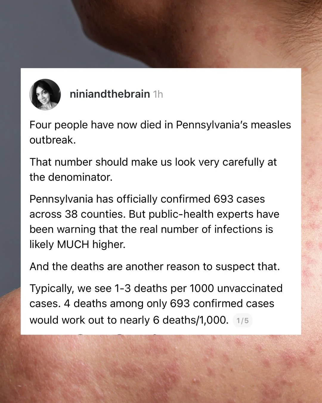 Back from a much needed break on here. And yeah, it&rsquo;s measles.