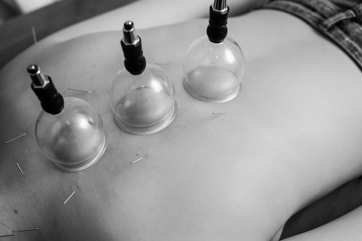 Cupping