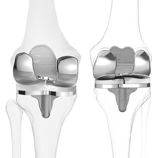 3d Printed Knee Replacement — Amir Qureshi Orthopaedic Surgeon Knee