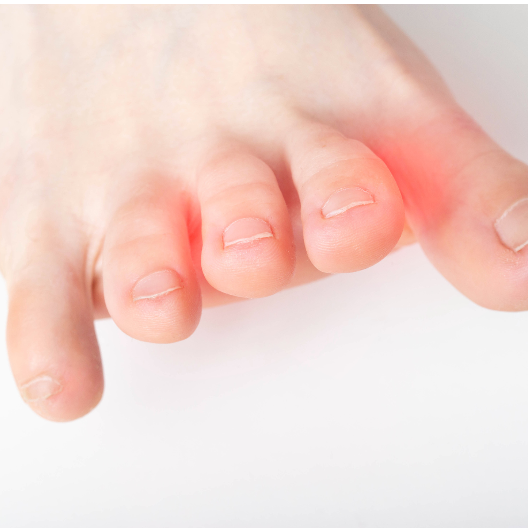 Intermetatarsal Neuroma