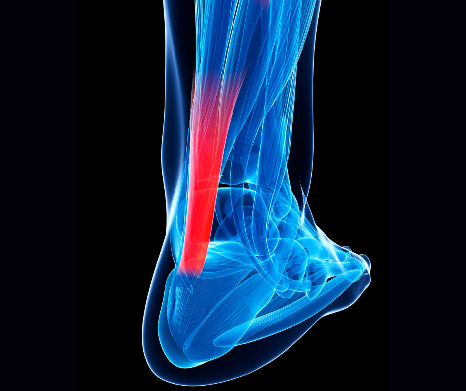 Posterior Tibial Neuralgia