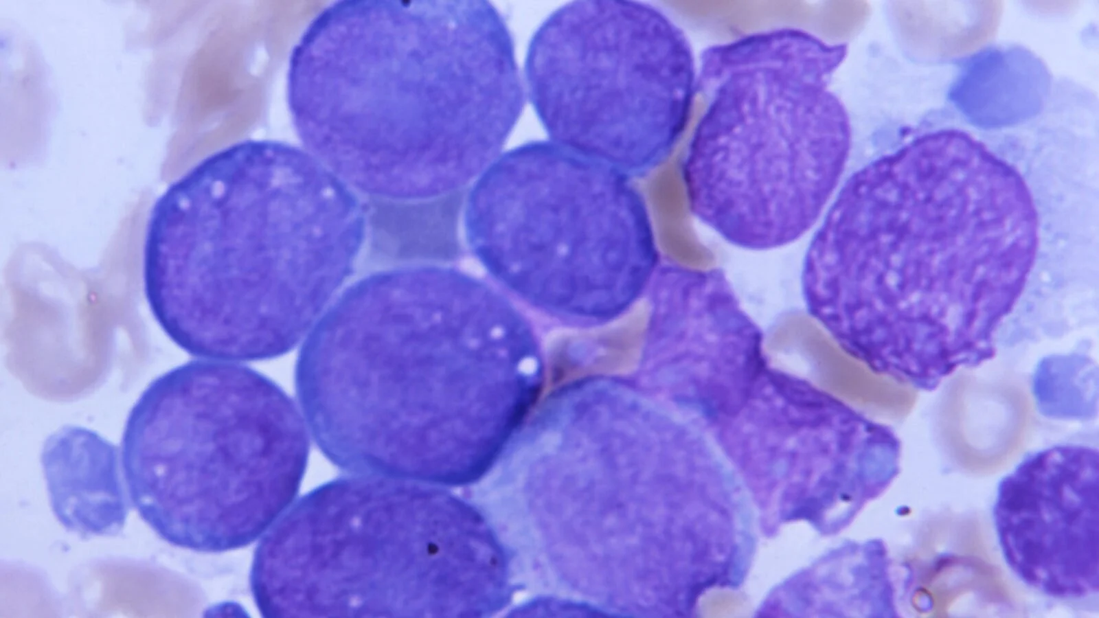 A bone marrow specimen from a patient with acute myeloid leukemia.CDC
