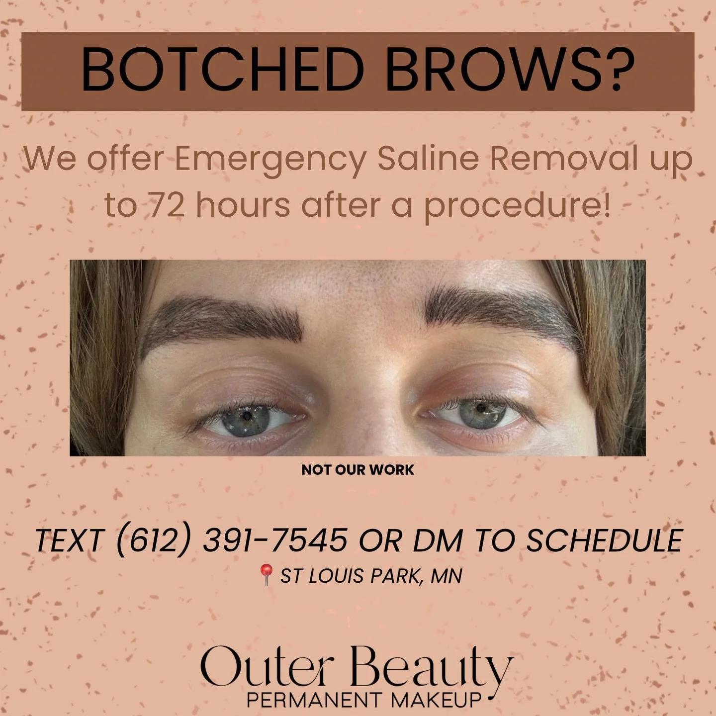 😣Emergency saline removal😣
This is not our work. Unfortunately, not all brow artists produce quality results.

Saline removal can be performed within 72 hours of the original procedure, but the first 48 hours provide the best outcome. If more than 