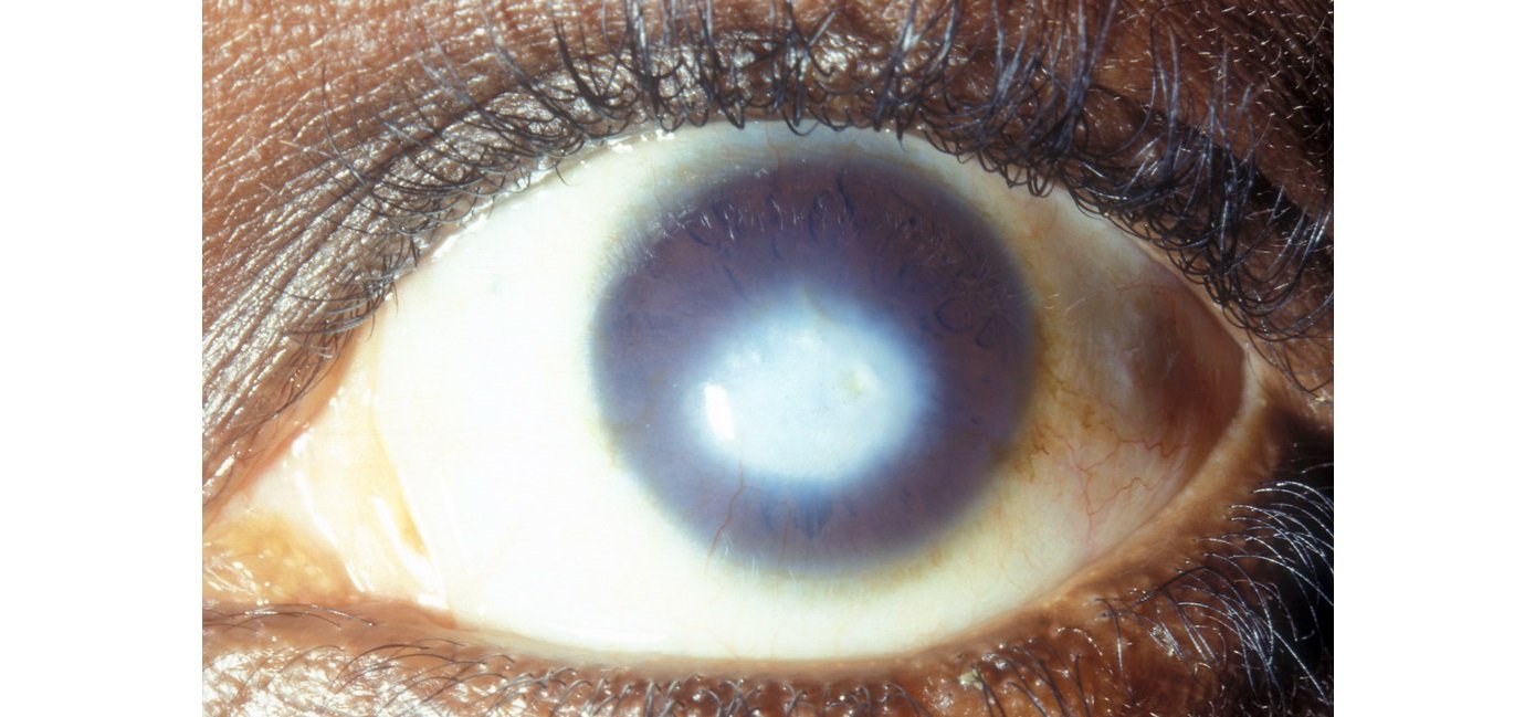 Can anyone tell me about the dark ring around my iris? Haven't seen it  often in others. : r/eyes