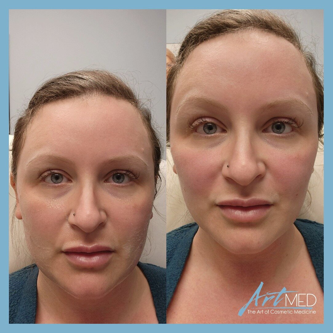 This is a before and after picture of ArtMed's clinic manager Stephanie.  She received 2 syringes of Revanesse Contour dermal filler with a focus on her cheeks and nasolabial folds. Injections were provided by our NP Alina Moyer (@alinamoyer). The go