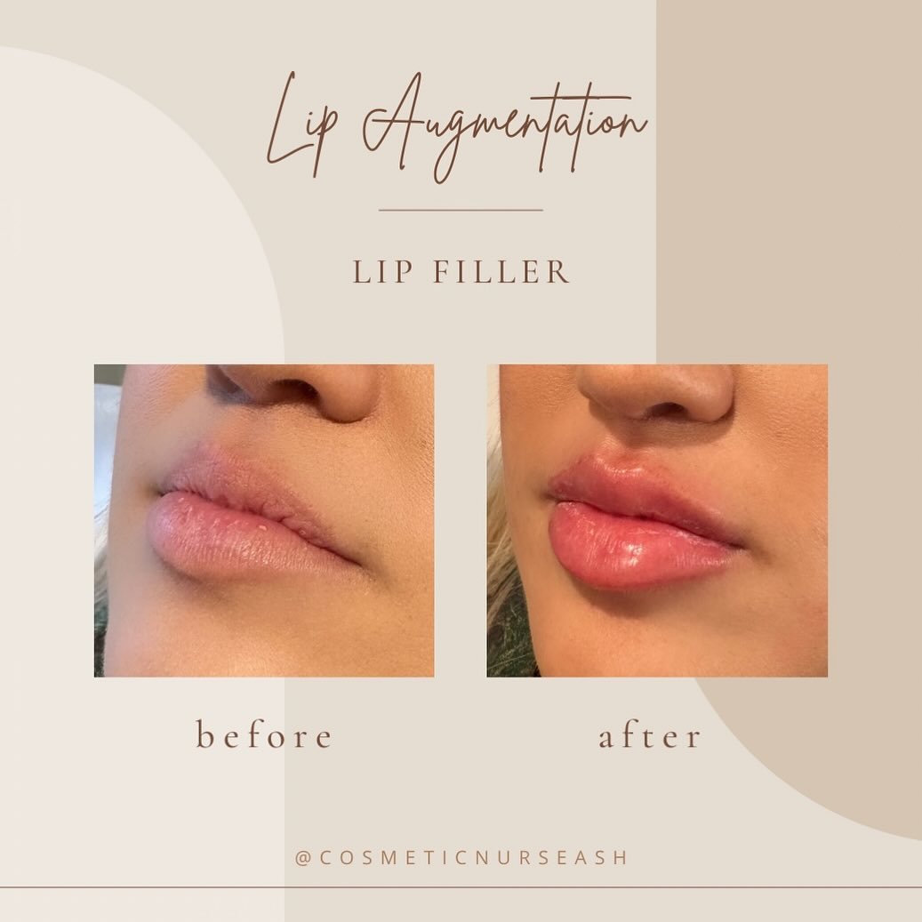 ✨LIP FILLER 💉

💉0.6ml was used between the upper + lower lip for this client, our goal was for creating symmetry, volume &amp; hydration

⭐️The before picture on the left is 2 weeks after dissolving her previous upper lip filler as you can see her 