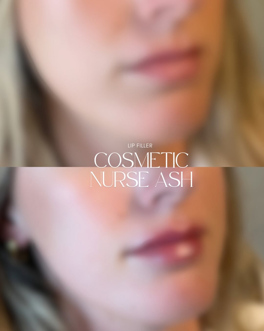 ✨Who doesn&rsquo;t love all things LIPS? 

Obsessed with this Before &amp; After 🫦

💉0.6ml of dermal filler was used between the upper &amp; lower lip for this beautiful client, we have previously dissolved her filler and re-injected working with a