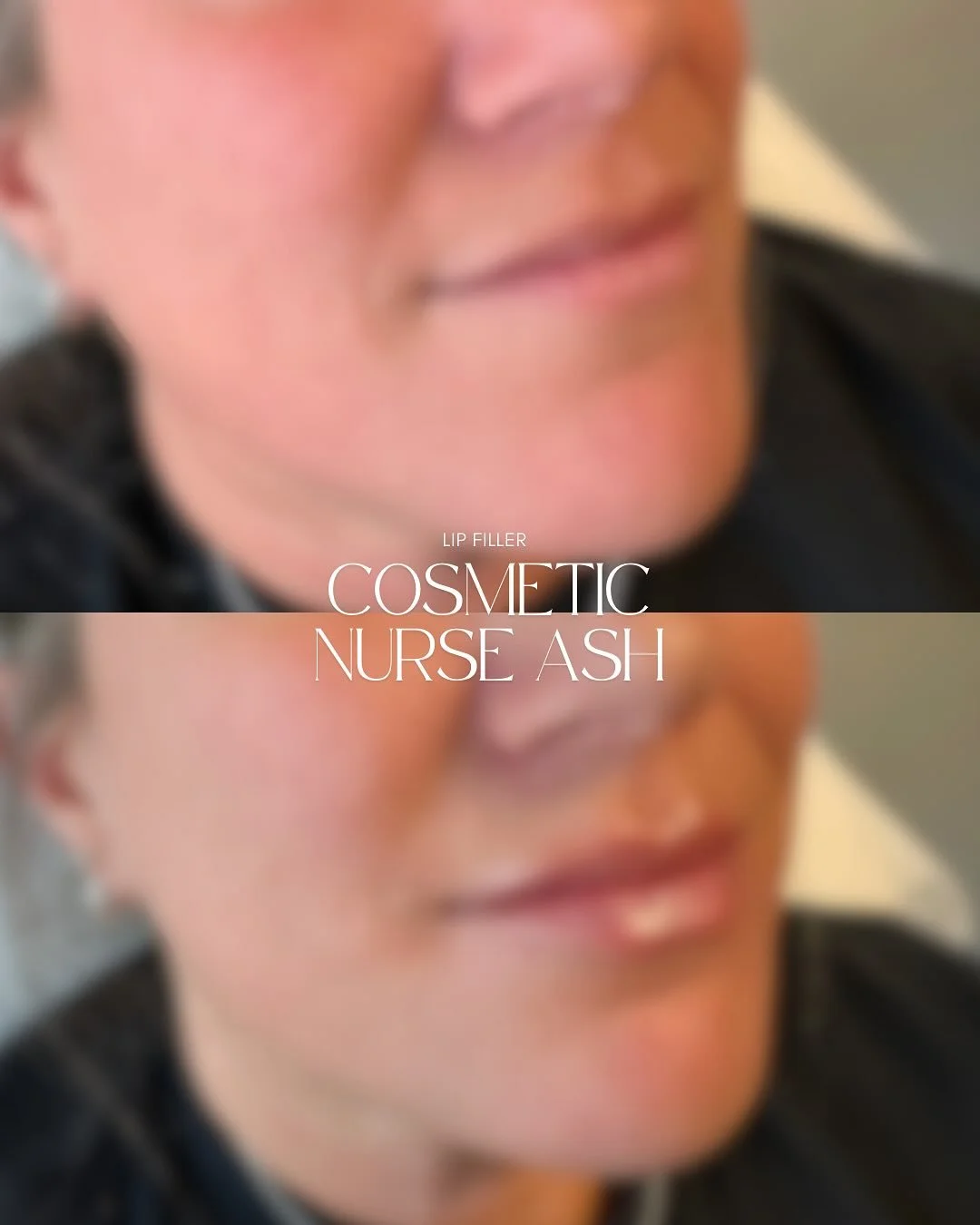 ✨Who doesn&rsquo;t love a fresh lip moment? 

Loving this beautiful result and stunning new look for this client 🫦

💉0.6ml of dermal filler was used to enhance the upper and lower lip. Our goal? To create soft symmetry, add subtle volume, and boost