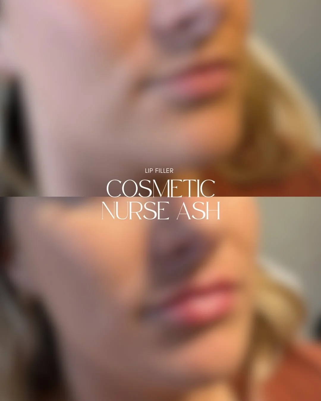 ✨Obsessed with this Before &amp; After 🫦

💉0.6ml of dermal filler was used between the upper &amp; lower lip for this beautiful client. Our goal was for creating symmetry, volume &amp; hydration for her 🧚🏼 We are so happy with her results!! She i