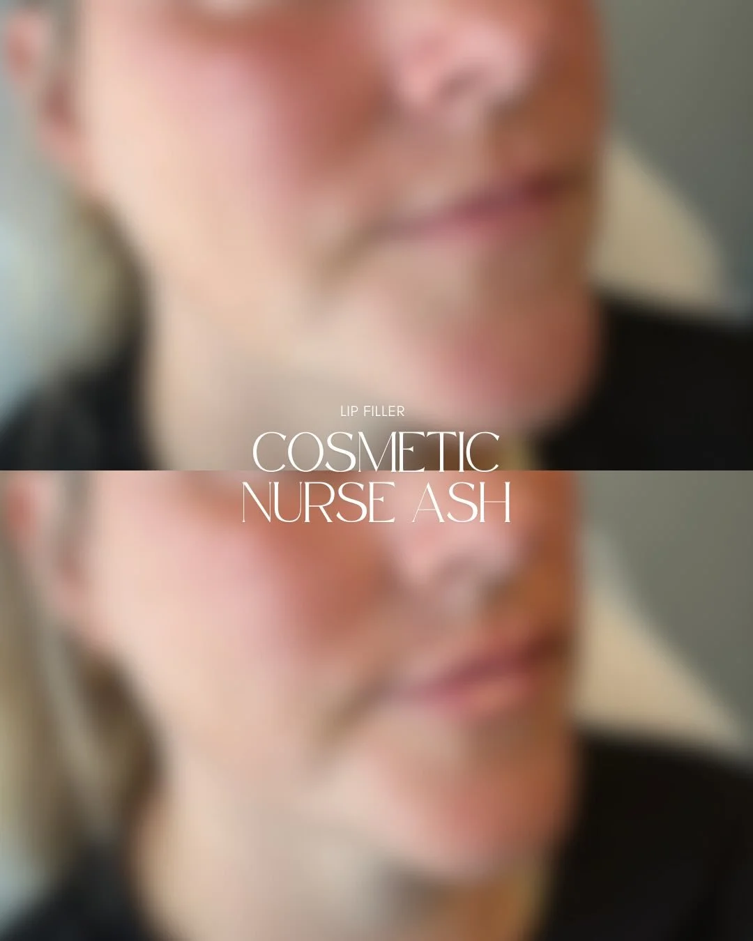 💫 Happy Sunday Cuties!! I&rsquo;m LOVING this soft, natural result on this first-time lip filler client 🌸

💉 0.6ml was placed between the upper &amp; lower lip for subtle volume, hydration and a balanced natural lip 🩷

✨ Book a free consultation 