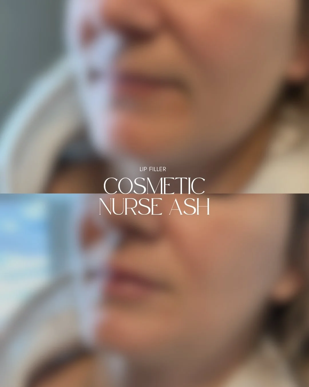 ✨I&rsquo;m loving this soft, natural result for this client 🌸

💉 0.6ml was placed between the upper &amp; lower lip for subtle volume, hydration &amp; a balanced natural lip 🤍

Book a free consultation to create a plan tailored just for you. Booki