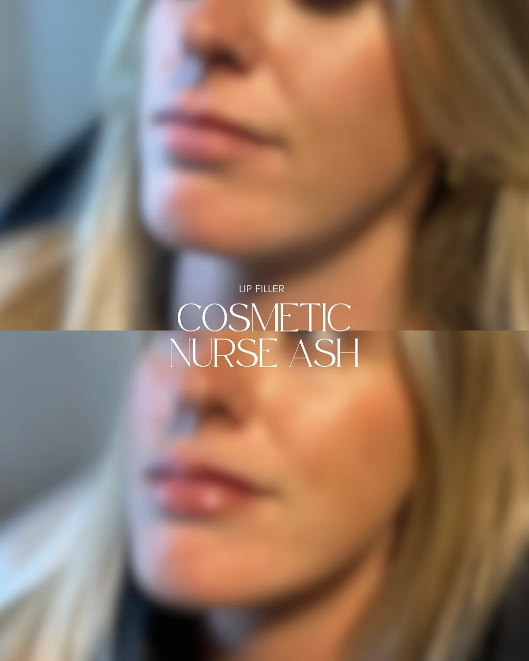 ✨Before &amp; After 🫦

💉0.6ml of dermal filler placed between the upper &amp; lower lip to enhance symmetry, restore volume and boost hydration. The result? Fresh, balanced and natural 👌🏻 This beautiful client and future bride is absolutely glowi