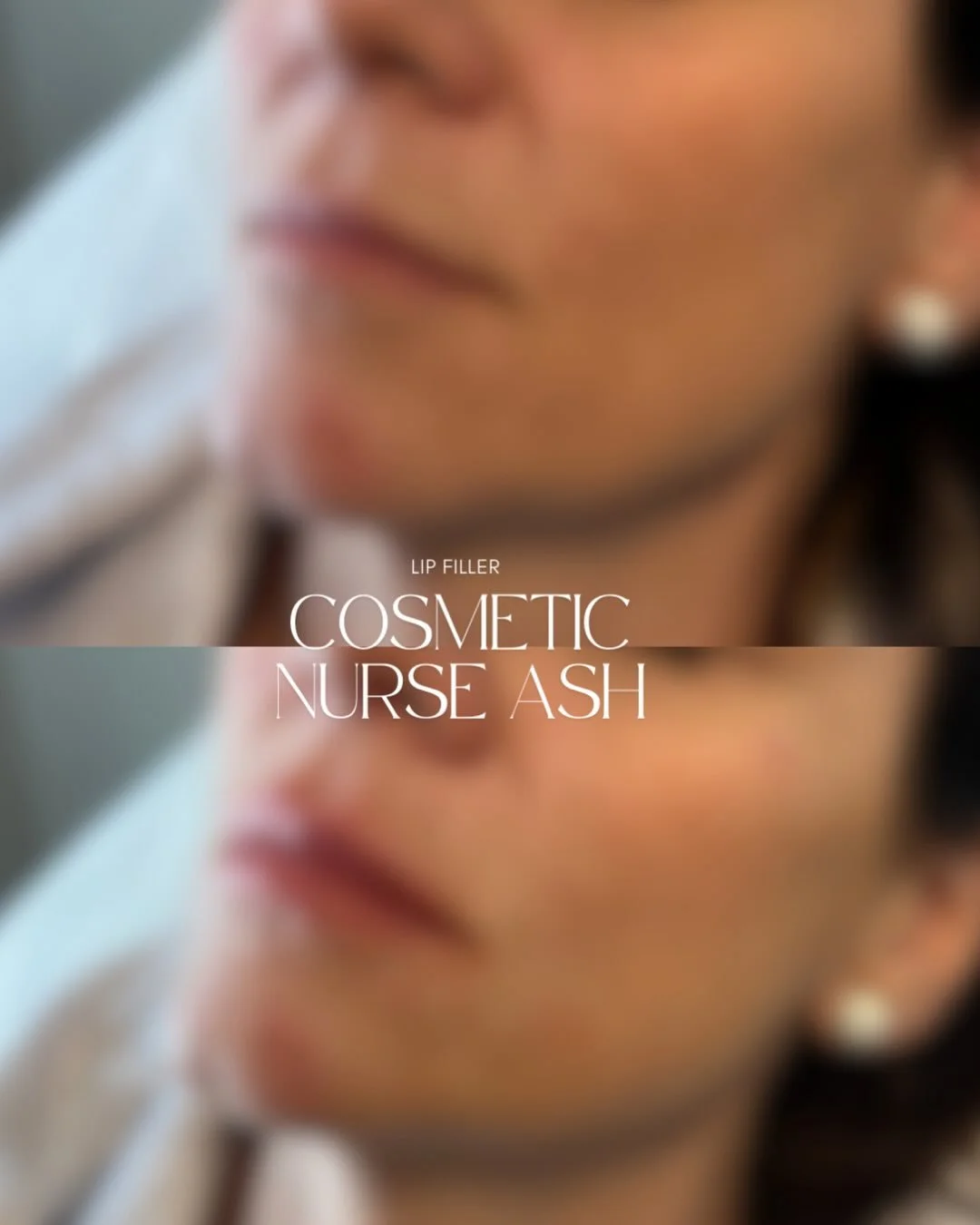 ✨She&rsquo;s ready for the mistletoe&hellip; 🫦

💉 0.6ml of dermal filler placed to subtly enhance symmetry, add soft volume, and boost overall lip hydration. The result is a fresh, balanced, and naturally beautiful look 👌🏻

This lovely client is 