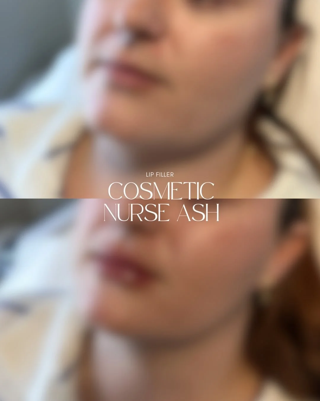 ✨A little filler, a whole lot of confidence 🫦

Subtle volume, enhanced shape, and plump hydrated lips, all tailored to her beautiful features 💄

Ready for your lip glow-up? 💫

My booking through Jane is open for June &amp; July now

☀️ Book your s