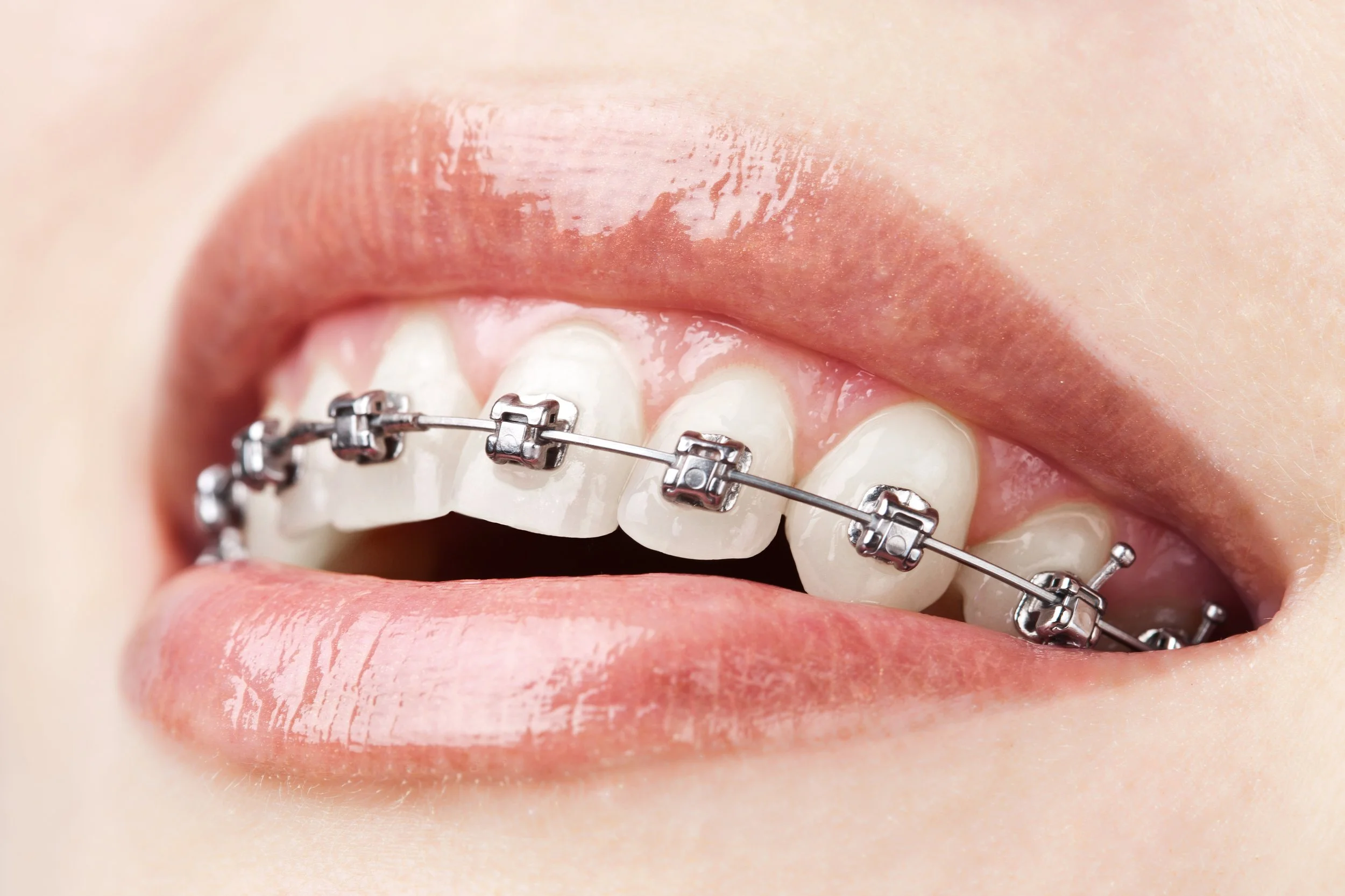 What Is an Orthodontic Screening? 
