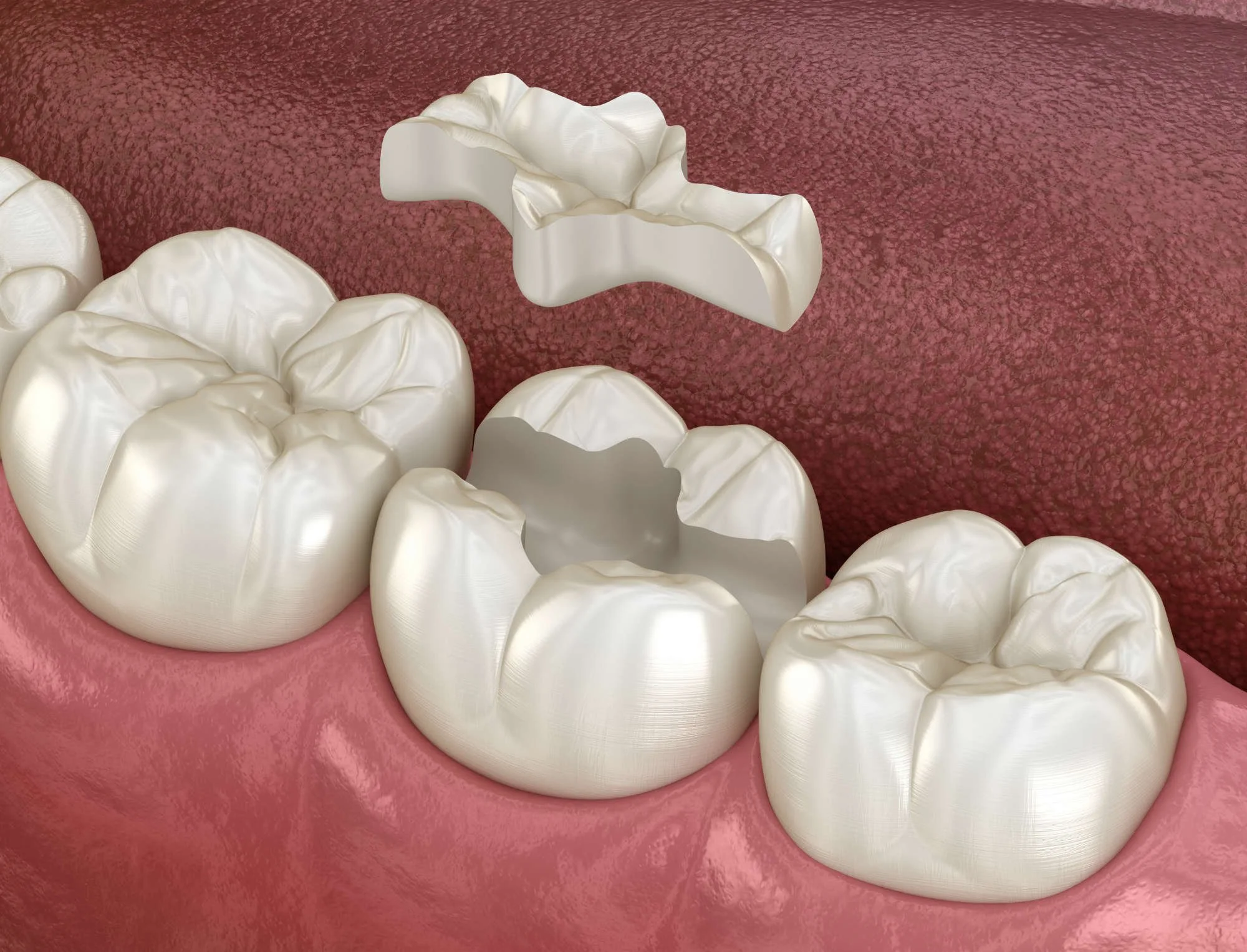 What Are Dental Onlays?