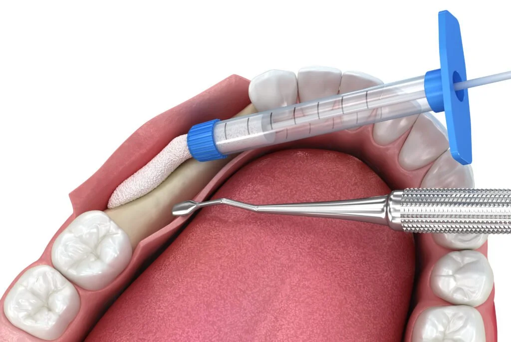 How Long Does It Take for a Dental Bone Graft to Heal?