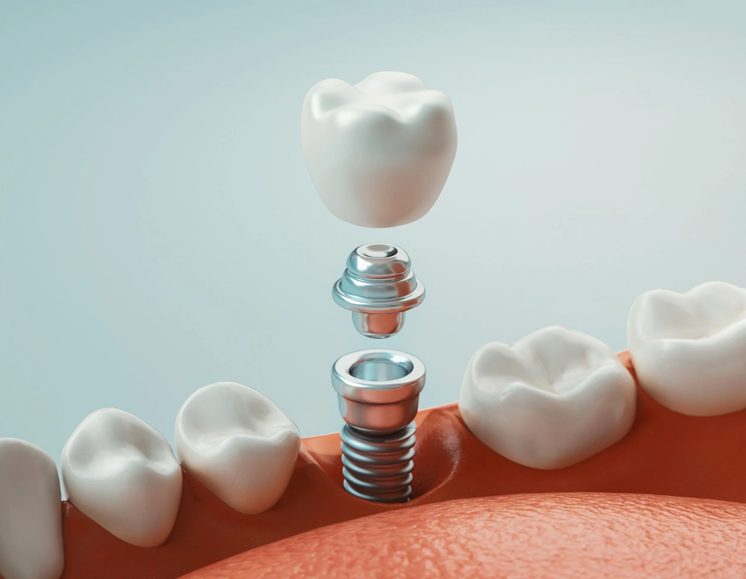 Why Are Dental Implants So Popular?