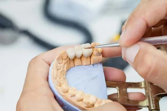 Do I Need a Bone Graft for a Bridge?