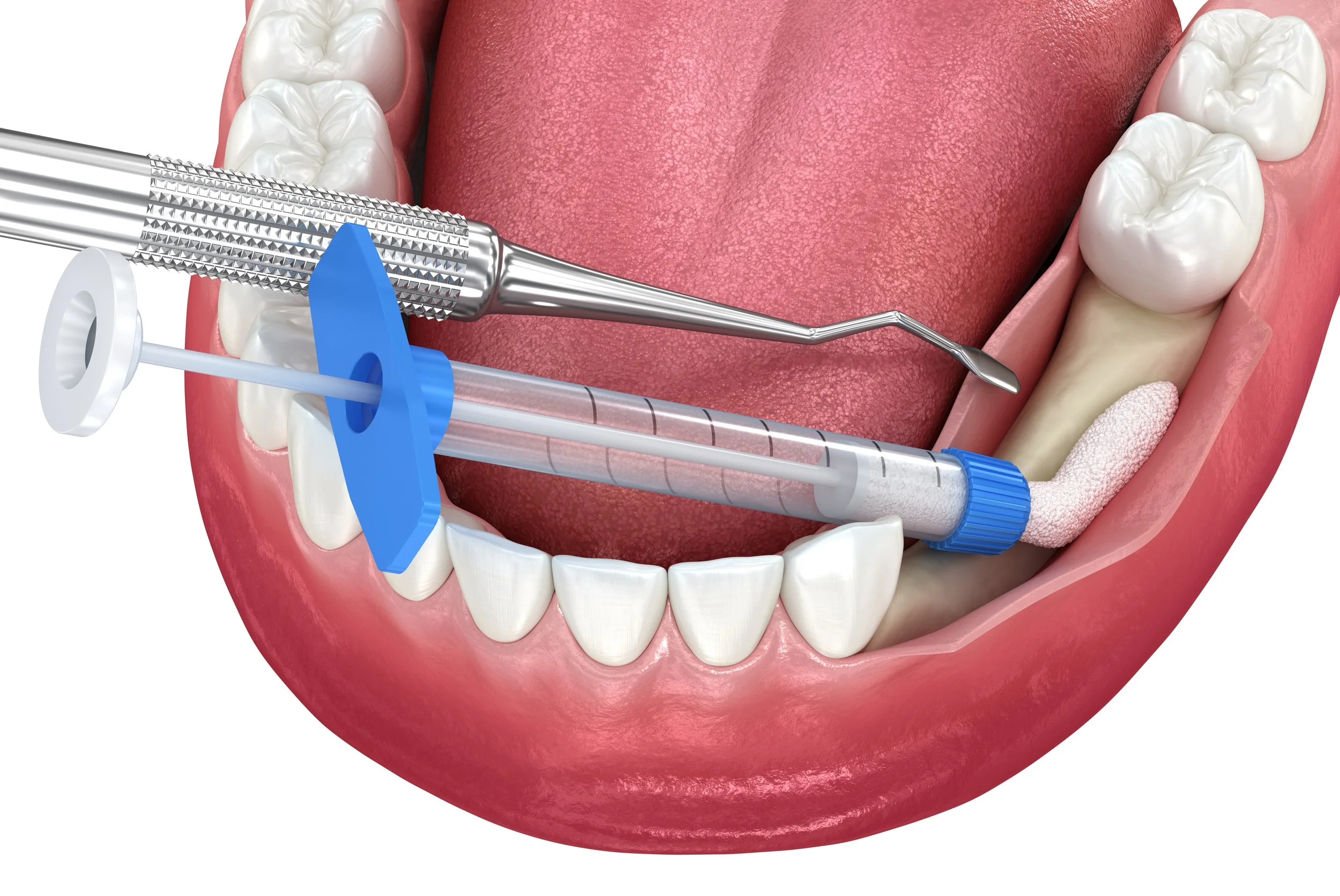 What Is Bone Grafting?