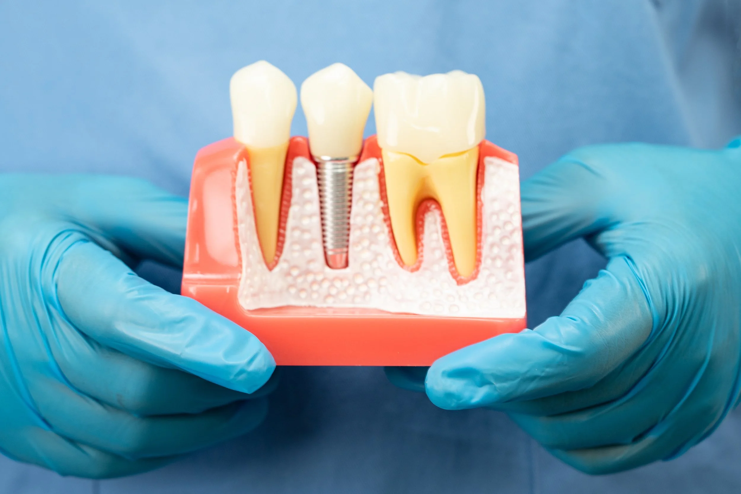 How Long Do Dental Implants Last?