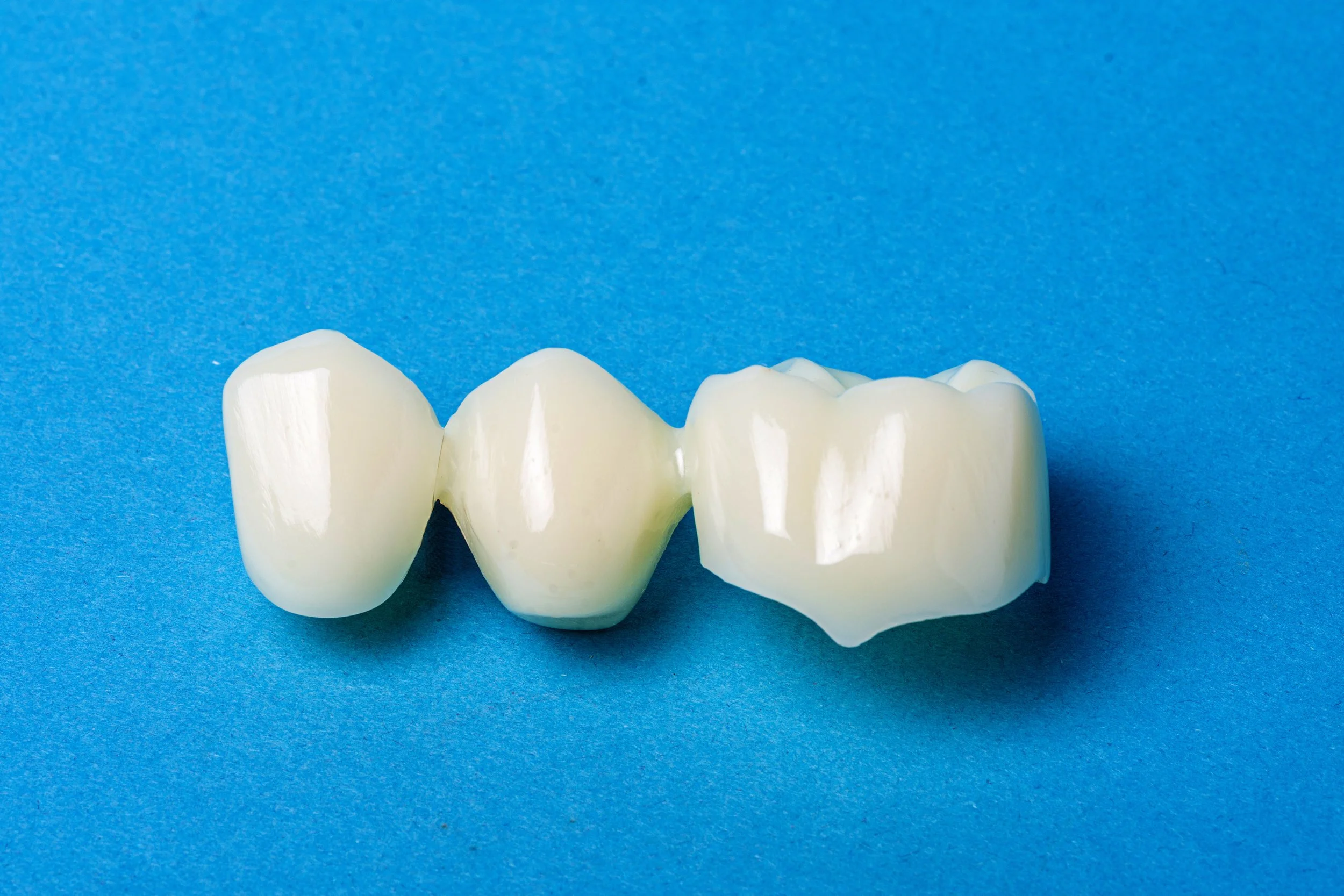 How Long Does a Porcelain Bridge Last?