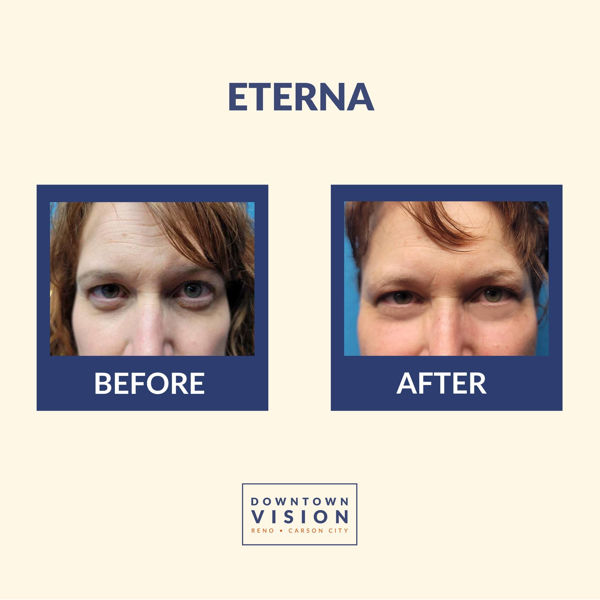 Experience the magic of controlled heat energy! Radio Frequency treatment gradually unveils a more youthful and rejuvenated appearance by stimulating collagen production. Say hello to refreshed, youthful eyes and goodbye to crow's feet! 👋