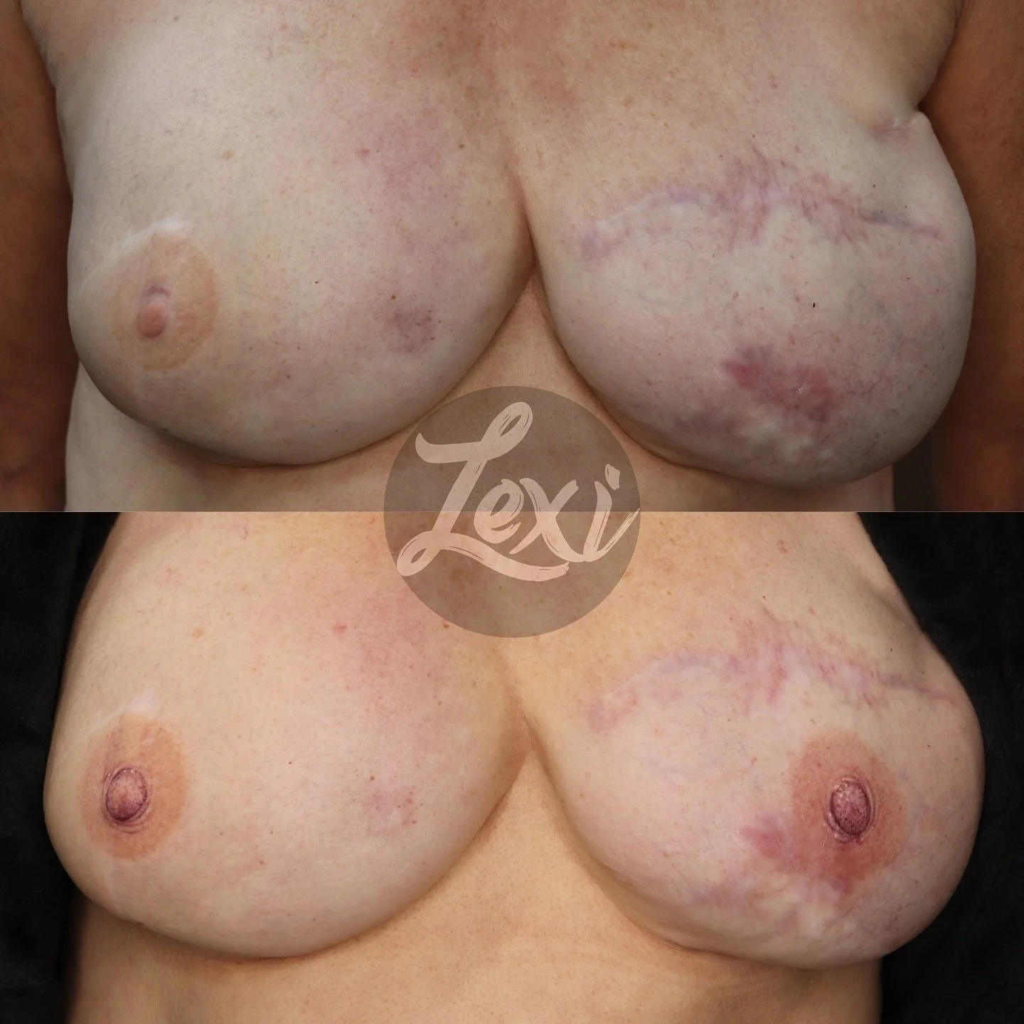 Post Mastectomy Breast Cancer Tattooing * 
TATTOOS to restore her nipple she lost 🤍 Thank you IG for allowing me to share with survivors 🙏 
  Top photo is before and bottom is healed tattoo >>> right photo is freshly done. Her right nipple