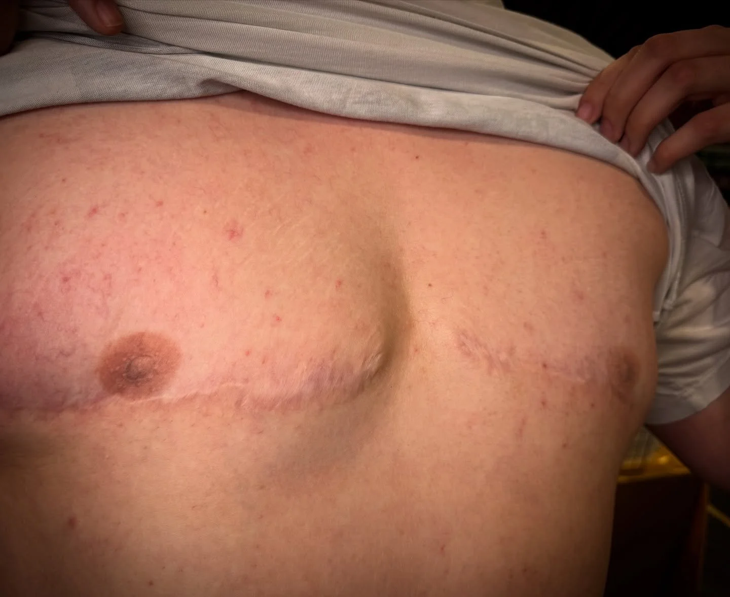 Healed male nip tattoos, about four years. Thanks to my client for stopping by my booth at the Lloyd minster tattoo convention 🤍 @bordercity_tattoo_expo  #transformation