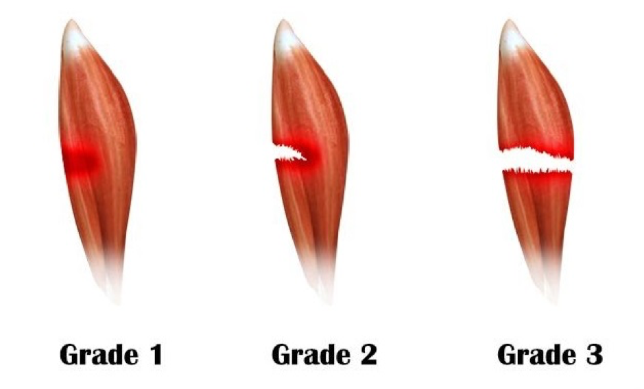 How Long Does It Take For A Calf Strain To Heal? — Neel Raval, M.D.