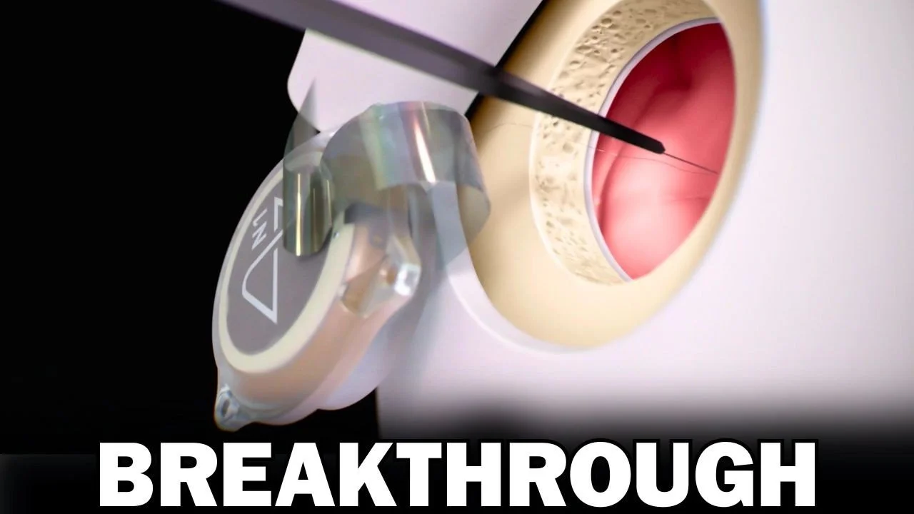 Neuralink Threads Electrodes Through the Dura in First Transdural Surgery